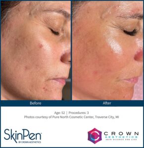 Microneedling 8 B & A Traverse City 1