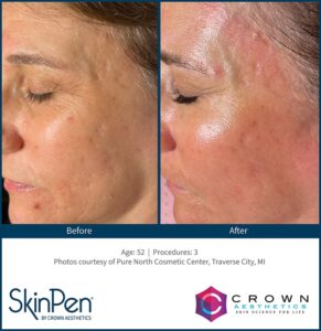 Microneedling 9 B & A Traverse City 2