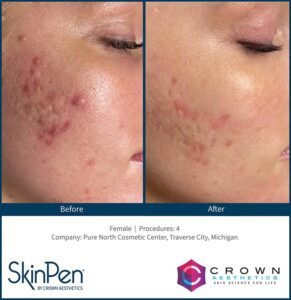Microneedling 14 bA Acne Scar 4 Treatment