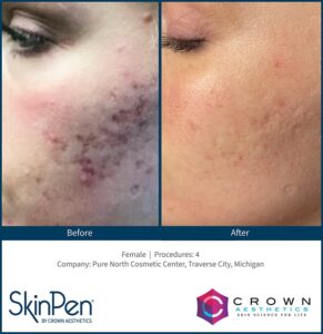 Microneedling 7 BA Acne Scar 4 Treatment
