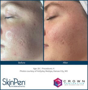Microneedling 13 B & A