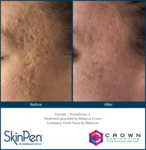 Microneedling 11 BA Skinpen Acne Freshfaces Rebecc Crow