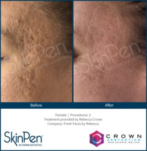 Microneedling 10 BA Skinpen Acne Freshfaces Rebeccacrow WM