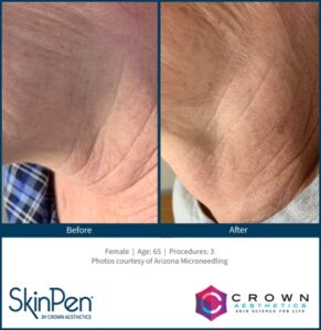 Microneedling 12 BA Skinpen Flaw KH Neck Arizona Microneedling 3 Treatments-65YO-img