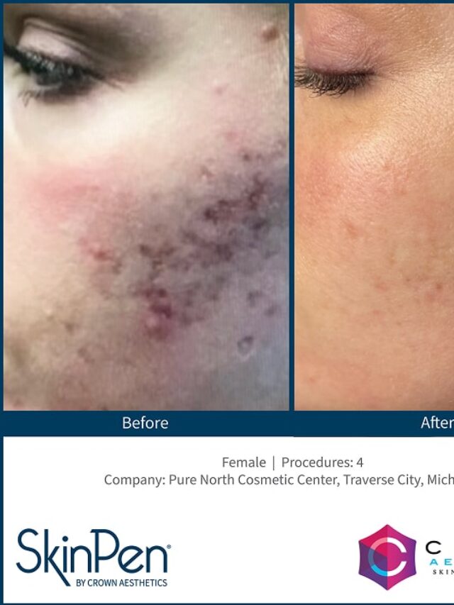 Acne Scars That Just Won’t Fade?