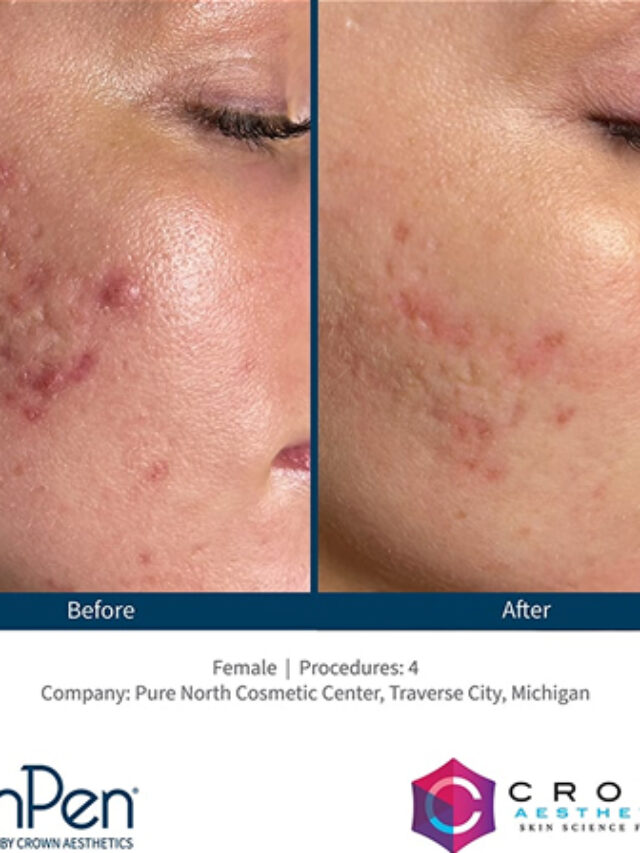 Tired of dull, uneven skin? See how microneedling changes everything!