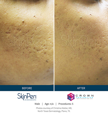 Microneedling 6 medical grade img