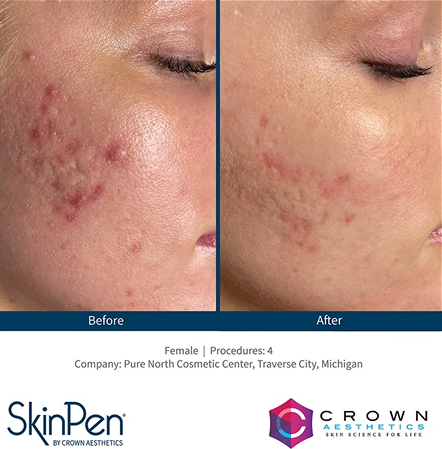 Microneedling 2 microneedling collagen therapy img 1