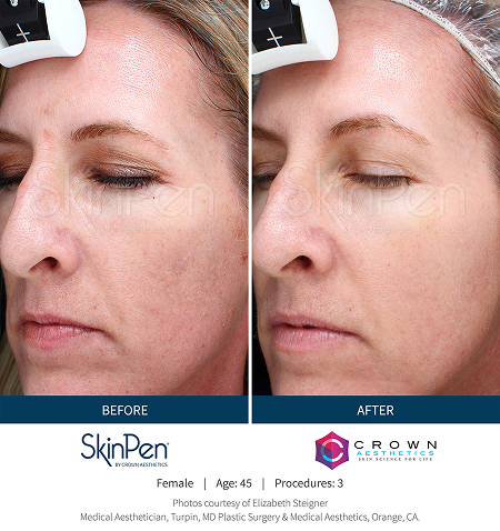Microneedling 4 skin concerns img